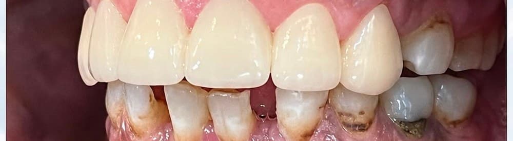 After Zirconia Crown Restoration