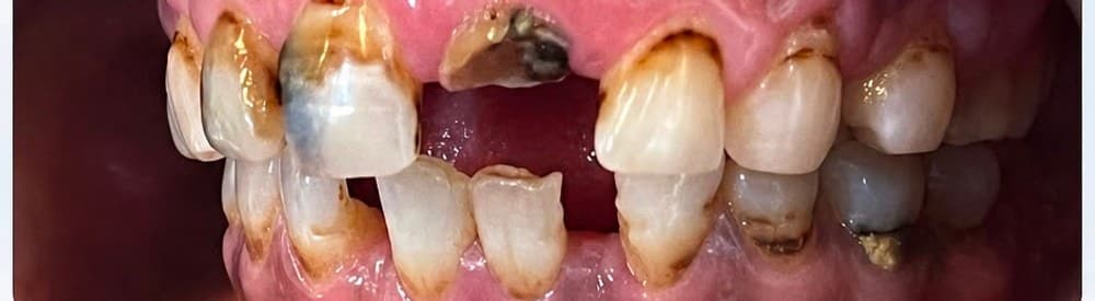 Before Zirconia Crown Restoration