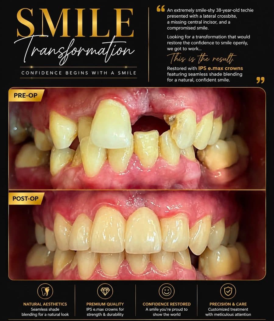 Smile Transformation with e.max Crowns