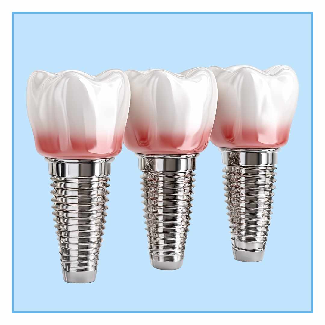 Dental Implants in Frazer Town