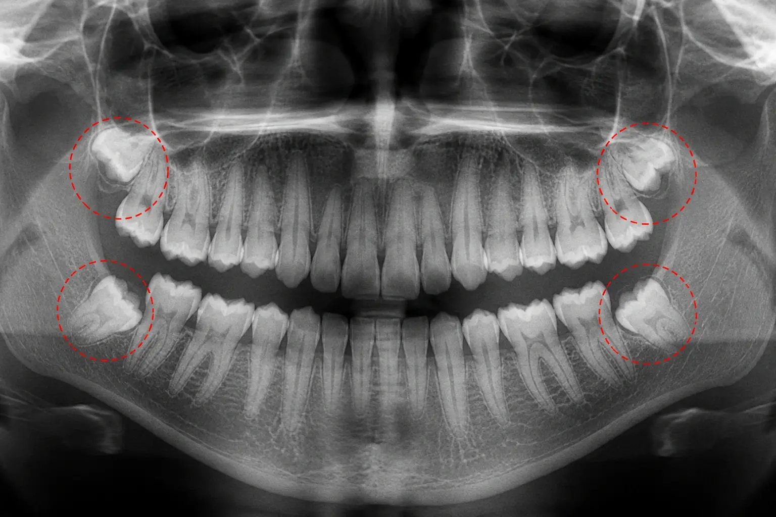 Wisdom Tooth Extraction in Frazer Town